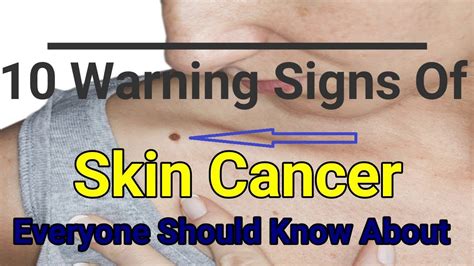 10 Warning Signs Of Skin Cancer Everyone Should Know About Youtube