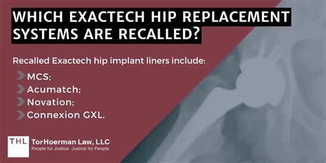 Exactech Hip Replacement Recall Lawsuit Latest Updates