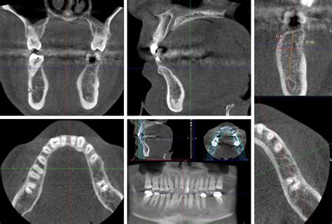 Dental CT Scan Vs Cone Beam CT An Overview ITI Blog