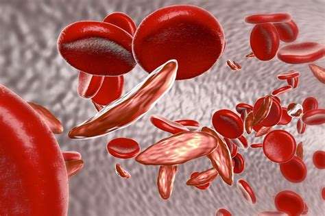 Anemia Falciforme O Que é Sintomas E Tratamentos Dicas De Saúde