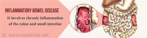 Inflammatory Bowel Disease Causes Symptoms Diagnosis Treatment And Prevention