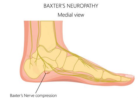 Baxters Nerve Entrapment Heel Pain Pinched Heel Nerve Treatment