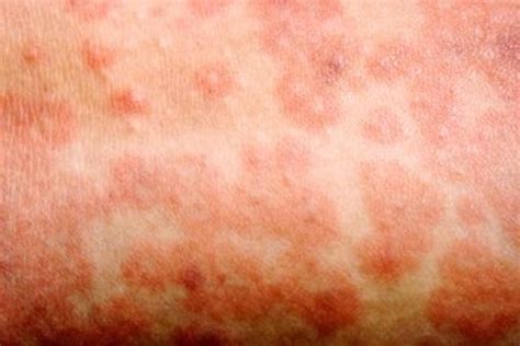 Measles Outbreaks In Europe Easter Travel Advice Govuk