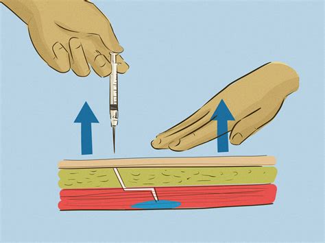 Expert Advice On How To Give An Intramuscular Injection Wikihow