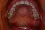 Itchy Tongue And Roof Of Mouth