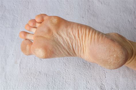 How To Treat And Prevent Calluses My Site