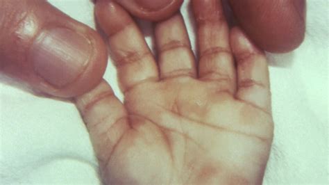 Congenital Syphilis Is Back Newborn Babies Are Its Tragic Victims Stat