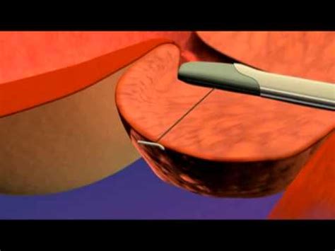 Urolift Implant The Prostate Clinic Youtube