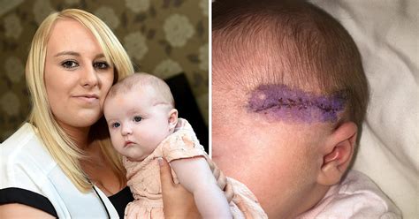 Baby Left With Facial Scar After Head Is Sliced By Surgeon During C