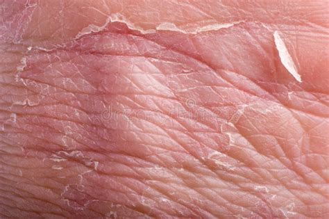 Eczema On Finger Stock Photo Image Of Painful Rash Detail 3866210