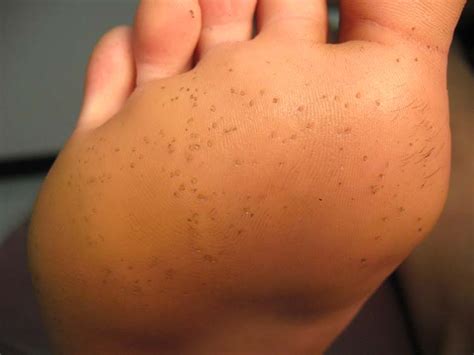holes in skin on bottom of feet images and photos finder