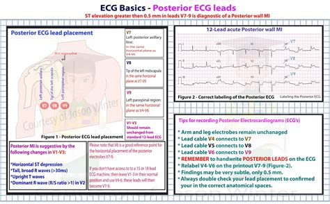 18 Lead Ekg Placement Diagram