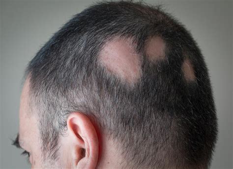 Environmental reasons are the most common attributes to hair loss. Alopecia areata: Symptoms, treatment, and tips