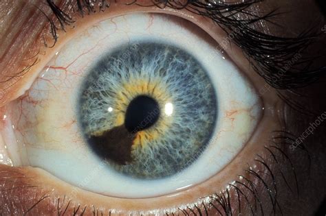 Eye Cancer Stock Image C0184304 Science Photo Library