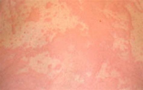 Stress Rash Causes Symptoms Pictures And Treatment