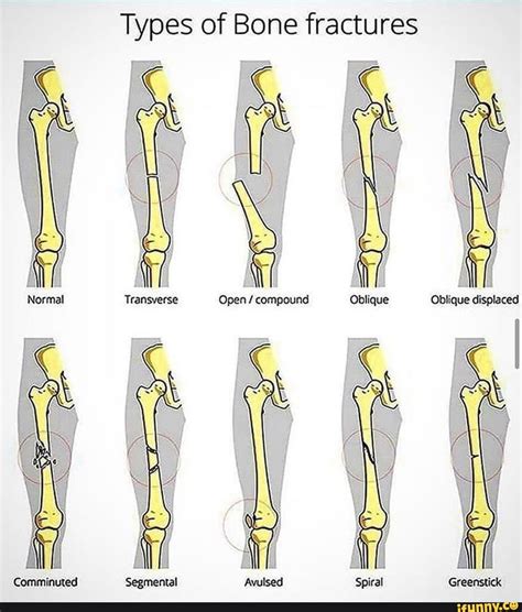 Compound Fracture Diagram Photos Cantik