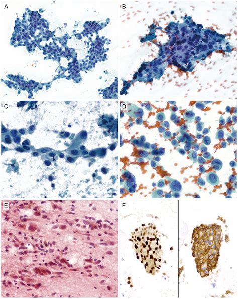 Salivary Duct Carcinoma Updates In Histology Cytology Molecular