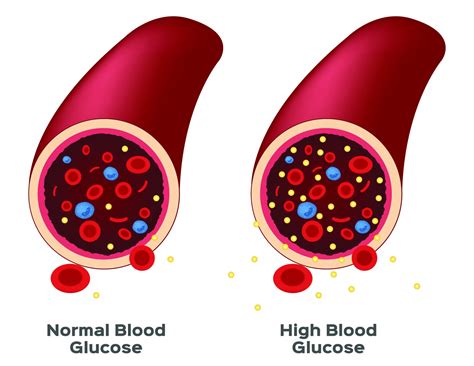 What Is High Blood Sugar Bloodglucosevalue Com