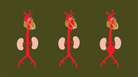 Enlarged Aorta Risks Symptoms And Treatment What To Know
