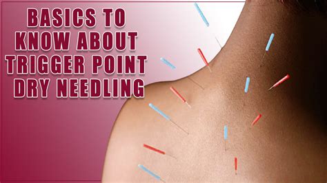 What To Expect From Reliable Trigger Point Dry Needling Expert Guide Lawtonphysicaltherapy