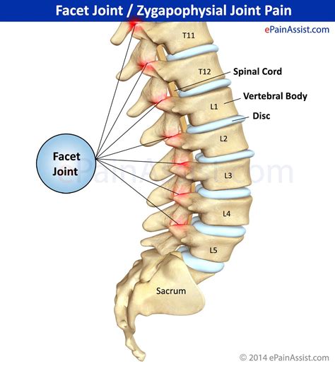 Facet Joint Or Zygapophysial Joint Pain Treatment Causes Symptoms