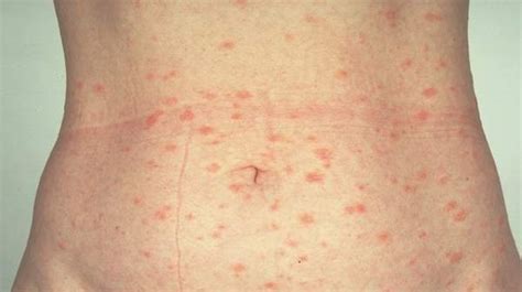 Pityriasis Rosea Get Facts On Symptoms Treatments And Causes Health