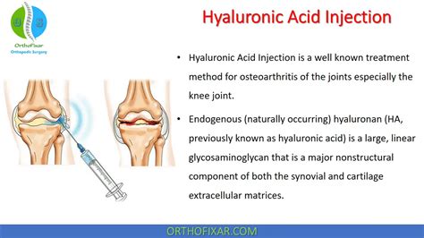 Hyaluronic Acid Injections How Do They Treat Arthritis 43 Off