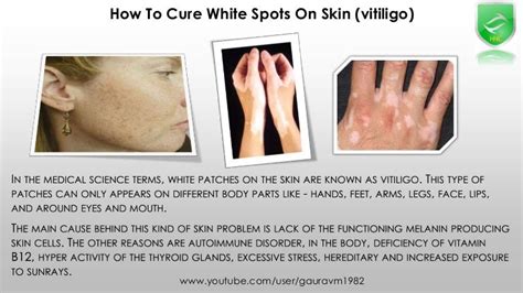 Vitamin Deficiency White Patches On Face