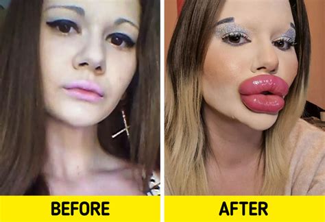 A Woman Does Injections To Look Like A Bratz Doll Says Peoples