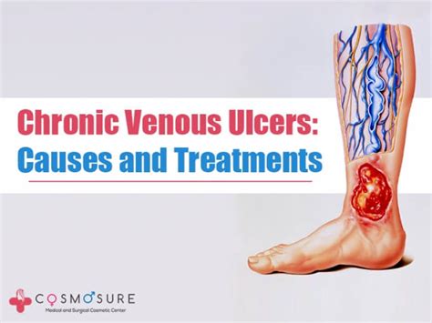 Chronic Venous Ulcers Causes And Treatments Cosmosure Clinic