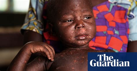 Measles Stalks Central African Republic In Covids Shadow In Pictures