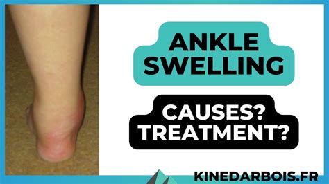 Demystifying Ankle Swelling Uncovering The Causes Behind It
