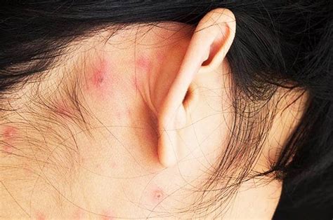 Home Remedies For A Pimple Behind The Ear —