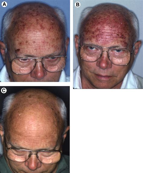 Actinic Keratosis From The Skin To The Lip Journal Of Oral And