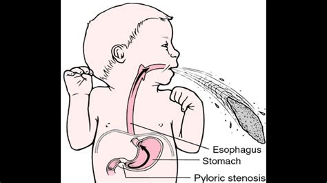 Pyloric Stenosis Congenital Diaphragmatic Hernia Paediatric Anesthesia