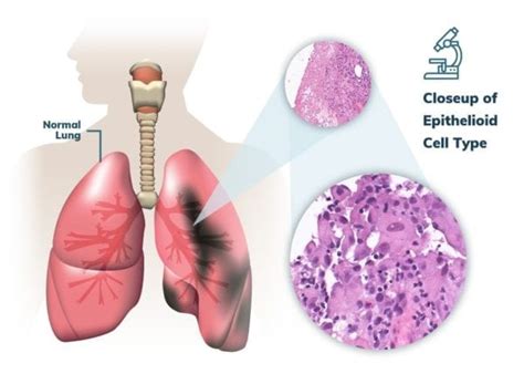 This type of medication is given through the bloodstream to reach cancer cells throughout the body. Pleural Mesothelioma | Stages, Treatment & Prognosis