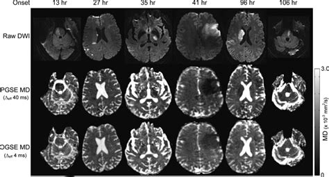 Reduction Of Diffusion Weighted Imaging Contrast Of Acute Ischemic