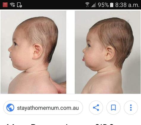 Hi My Baby Is 5month His Back Side Of Head Is Flat And