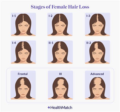 Top 48 Image Reasons For Hair Loss In Women Vn