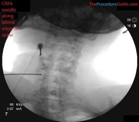 Fluoroscopic Guided Knee Genicular Nerve Radiofrequency Ablation The