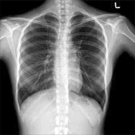Reading The Chest X Ray Chest Radiography Identifying A