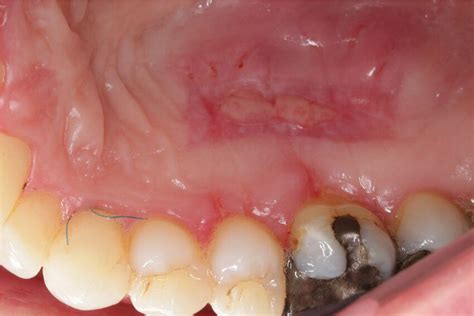 Suture Removal Of The Palatal Donor Site With Uneventful Healing And