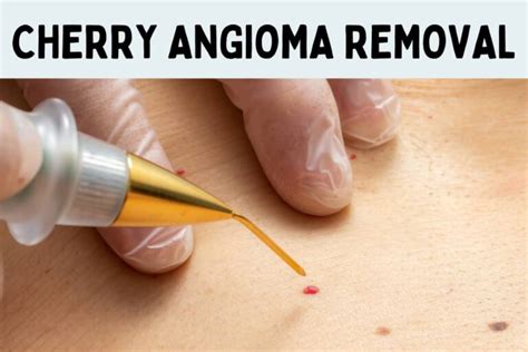 Removal Of Cherry Angiomas How To Get Rid Of Red Moles