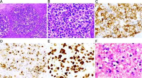 The most common type is mycosis fungoides. Extranodal NK/T-cell lymphoma. Histologic sections of a ...