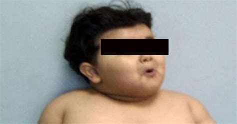 Obese Two Year Old Requires Surgery After Tipping The Scales At Over 5