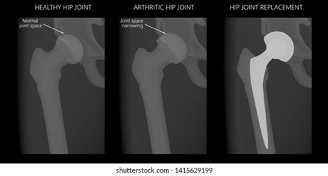 486 Total Hip Replacement Images Stock Photos And Vectors Shutterstock