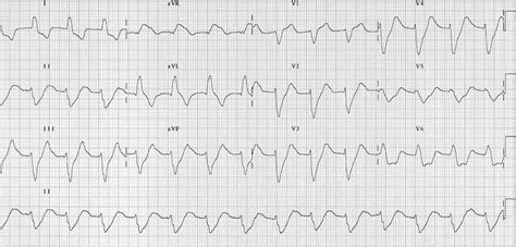 Ecg Rhythms Hyperkalemia Images And Photos Finder