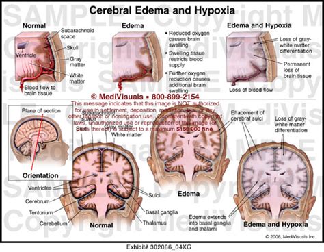 Cerebral Edema And Hypoxia Medical Illustration Medivisuals