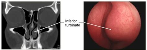 Septoplasty And Turbinate Reduction Sinushealth