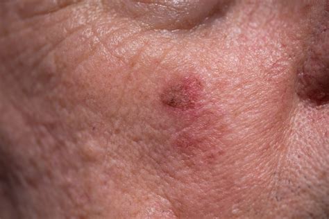Skin Cancers — The Skin Centre